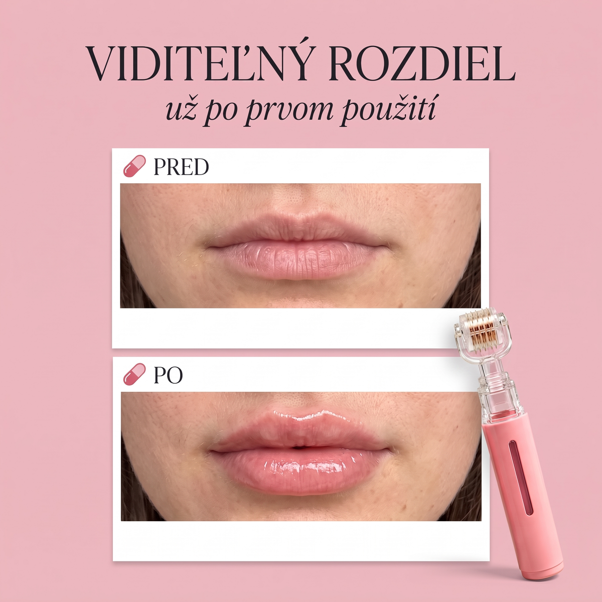 Lumea™ Lip Roller